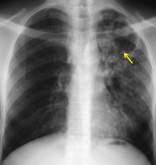 Tuberculose